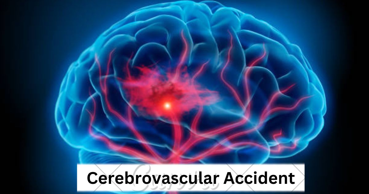 Cerebrovascular Accident