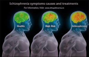 What Causes Schizophrenia
