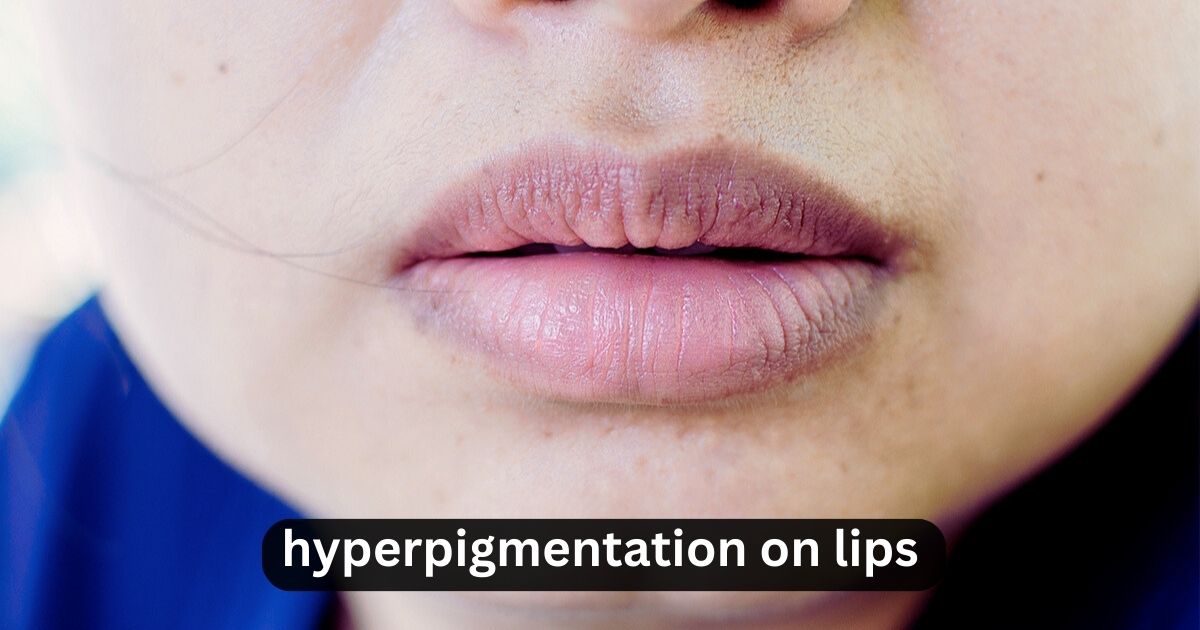 Hyperpigmentation On Lips